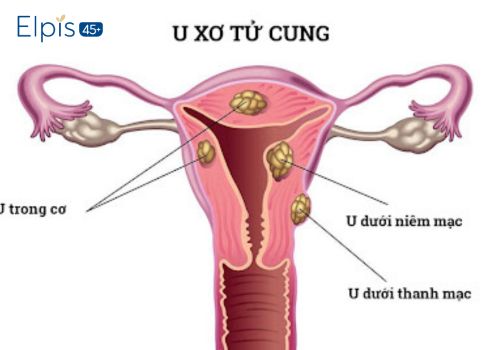 các bệnh viêm nhiễm phụ khoa thường gặp