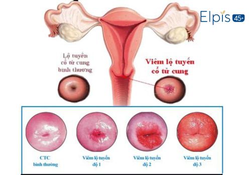 vùng kín có mùi hôi sau sinh mổ