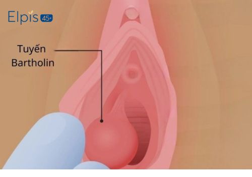 1 bên mép vùng kín bị sưng