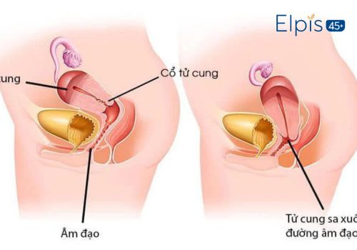 Nguyên nhân vùng kín sưng ngứa sau sinh